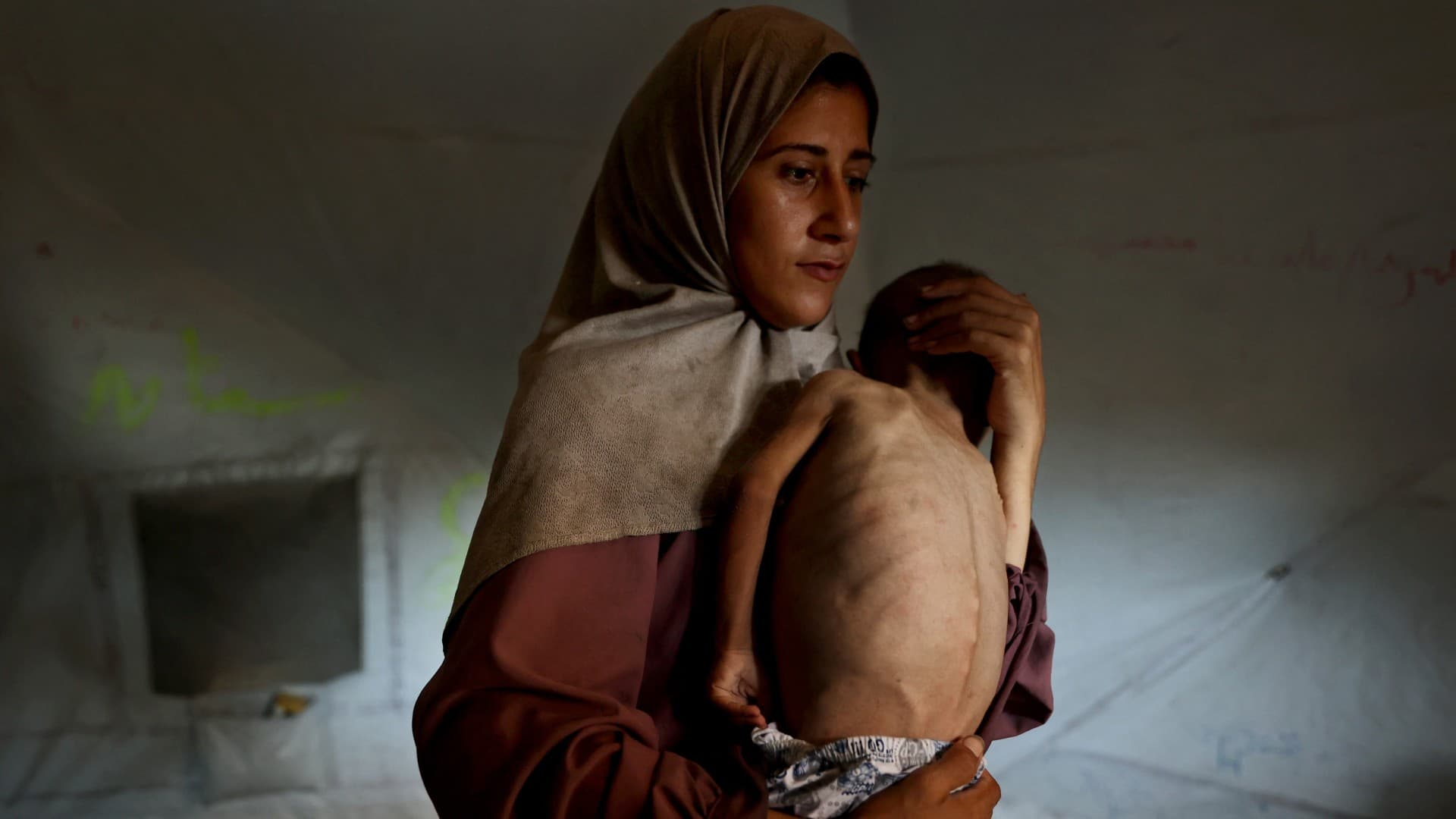 No, a Gaza toddler having cerebral palsy does not mean Israeli starvation is a ‘lie’